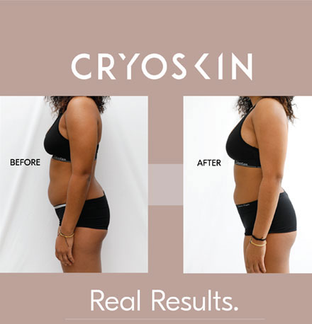 CRYOSKIN